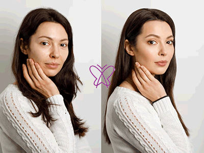 بوتاکس قبل و بعد