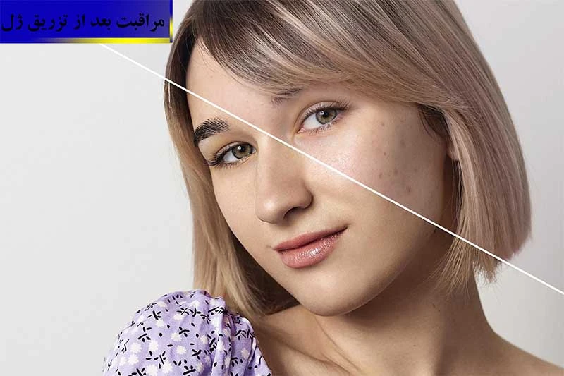 مراقبت بعد از تزریق ژل + کلینیک زیبایی آذین