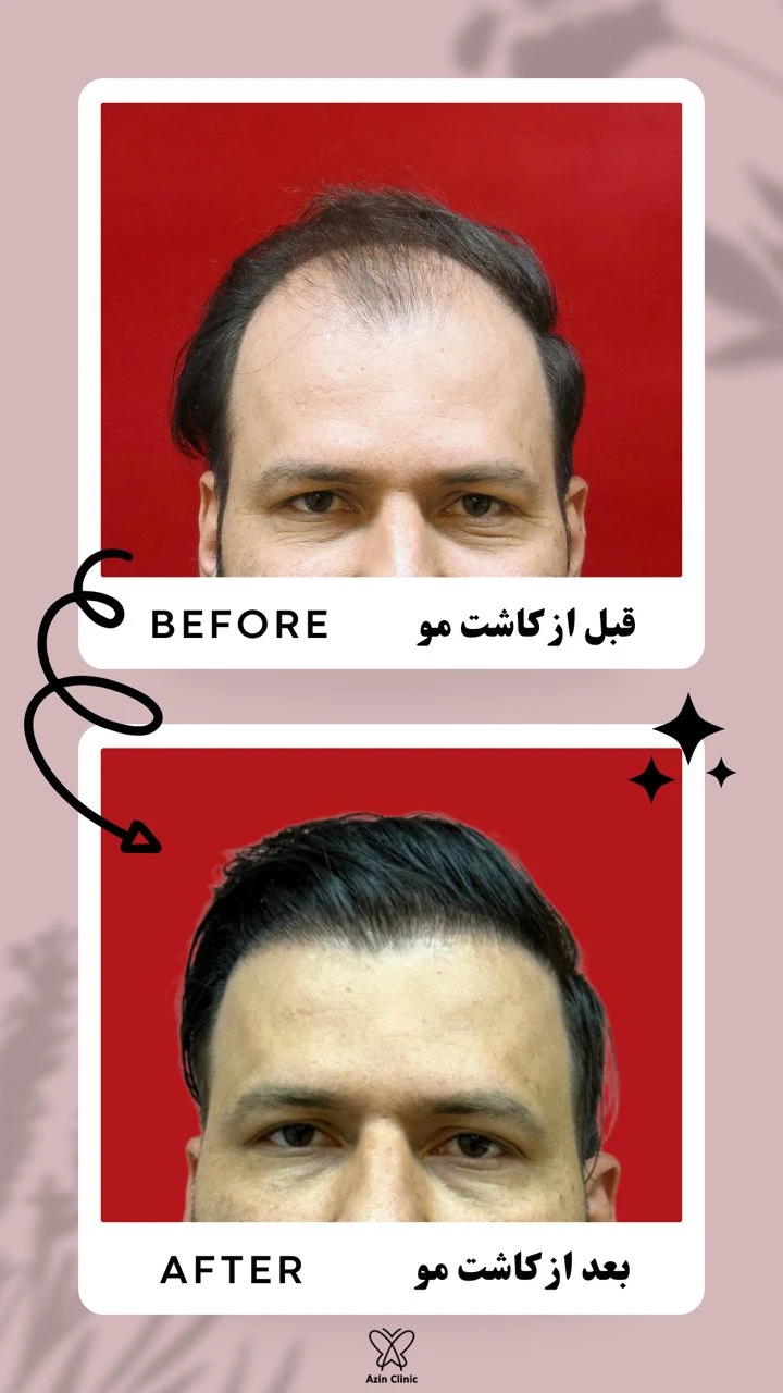 افزایش تقاضا برای کاشت مو طبیعی در ایران؛ دلیل استقبال مردم چیست؟